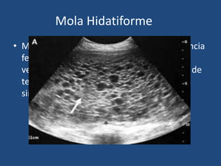 Mola Hidatiforme
• Mola Completa: Se caracteriza por la ausencia
fetal, degeneración hidrópica de las
vellosidades coriales e hiperplasia extensa de
tejido trofoblastico. (citotrofoblasto y
sinsitiotrofoblasto).
 