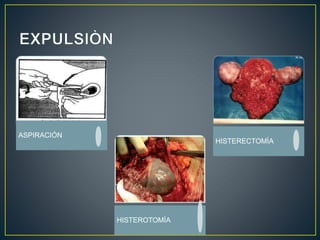 ASPIRACIÓN 
HISTEROTOMÌA 
HISTERECTOMÌA 
 