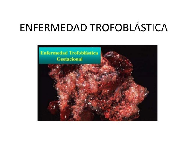 Enfermedades Trofoblasticas Pdf