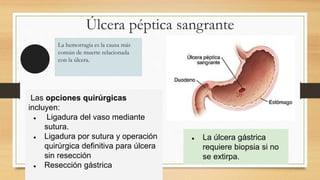 Úlcera péptica sangrante
La hemorragia es la causa más
común de muerte relacionada
con la úlcera.
Las opciones quirúrgicas
incluyen:
● Ligadura del vaso mediante
sutura.
● Ligadura por sutura y operación
quirúrgica definitiva para úlcera
sin resección
● Resección gástrica
● La úlcera gástrica
requiere biopsia si no
se extirpa.
 