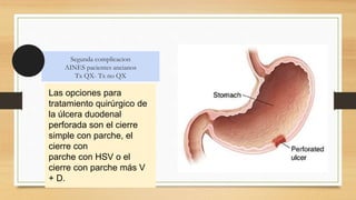 Úlcera péptica
perforada
Segunda complicacion
AINES pacientes ancianos
Tx QX- Tx no QX
Las opciones para
tratamiento quirúrgico de
la úlcera duodenal
perforada son el cierre
simple con parche, el
cierre con
parche con HSV o el
cierre con parche más V
+ D.
 