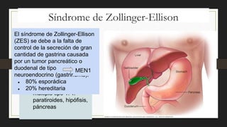 Síndrome de Zollinger-Ellison
● Neoplasia endocrina
múltiple tipo 1: T.
paratiroides, hipófisis,
páncreas
El síndrome de Zollinger-Ellison
(ZES) se debe a la falta de
control de la secreción de gran
cantidad de gastrina causada
por un tumor pancreático o
duodenal de tipo
neuroendocrino (gastrinoma).
● 80% esporádica
● 20% hereditaria
MEN1
 
