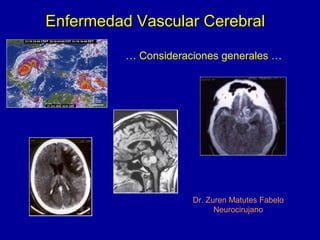 Enfermedad Vascular CerebralEnfermedad Vascular Cerebral
Dr. Zuren Matutes Fabelo
Neurocirujano
… Consideraciones generales …
 
