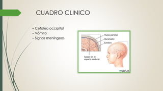 CUADRO CLINICO
– Cefalea occipital
– Vómito
– Sígnos meníngeos
 