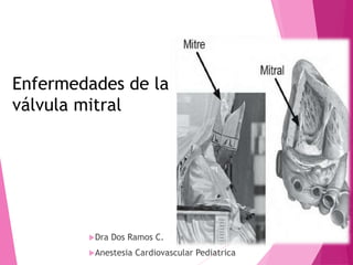 Dra Dos Ramos C.
Anestesia Cardiovascular Pediatrica
Enfermedades de la
válvula mitral
 