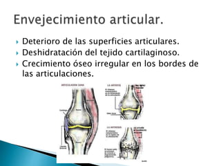  Deterioro de las superficies articulares.
 Deshidratación del tejido cartilaginoso.
 Crecimiento óseo irregular en los bordes de
las articulaciones.
 