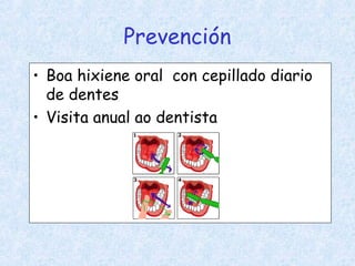 Prevención
• Boa hixiene oral con cepillado diario
de dentes
• Visita anual ao dentista
 