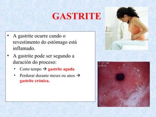 GASTRITE
• A gastrite ocurre cando o
revestimento do estómago está
inflamado.
• A gastrite pode ser segundo a
duración do proceso:
• Corto tempo  gastrite aguda
• Perdurar durante meses ou anos 
gastrite crónica.
 