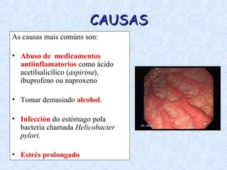 CAUSASCAUSAS
As causas mais comúns son:
• Abuso de medicamentos
antiinflamatorios como ácido
acetilsalicílico (aspirina),
ibuprofeno ou naproxeno
• Tomar demasiado alcohol.
• Infección do estómago pola
bacteria chamada Helicobacter
pylori.
• Estrés prolongado
 