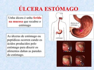 ÚLCERA ESTÓMAGO
Unha úlcera é unha ferida
na mucosa que recubre o
estómago
As úlceras de estómago ou
peptídicas ocorren cando os
ácidos producidos polo
estómago para dixerir os
alimentos dañan as paredes
do estómago.
 