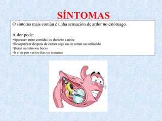 SÍNTOMAS
O síntoma mais común é unha sensación de ardor no estómago.
A dor pode:
•Aparecer entre comidas ou durante a noite
•Desaparecer despois de comer algo ou de tomar un antiácido
•Durar minutos ou horas
•Ir e vir por varios días ou semanas
 