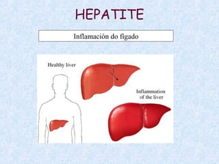 HEPATITE
Inflamación do fígado
 