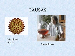CAUSAS
Infecciones
víricas
Alcoholismo
 