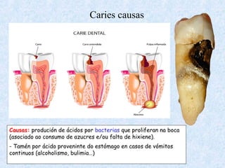 Caries causas
Causas: produción de ácidos por bacterias que proliferan na boca
(asociado ao consumo de azucres e/ou falta de hixiene).
- Tamén por ácido proveninte do estómago en casos de vómitos
continuos (alcoholismo, bulimia…)
 