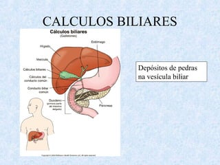 CALCULOS BILIARES
Depósitos de pedras
na vesícula biliar
 