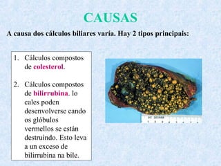 CAUSAS
1. Cálculos compostos
de colesterol.
2. Cálculos compostos
de bilirrubina. lo
cales poden
desenvolverse cando
os glóbulos
vermellos se están
destruíndo. Esto leva
a un exceso de
bilirrubina na bile.
A causa dos cálculos biliares varía. Hay 2 tipos principais:
 