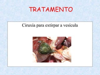 TRATAMENTO
Ciruxía para extirpar a vesícula
 