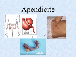 Apendicite
 