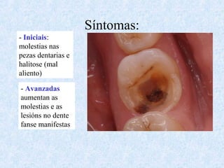 Síntomas:
- Iniciais:
molestias nas
pezas dentarias e
halitose (mal
aliento)
- Avanzadas
aumentan as
molestias e as
lesións no dente
fanse manifestas
 