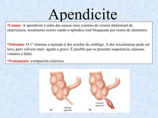 Apendicite•Causas: A apendicite é unha das causas mais comúns de ciruxía abdominal de
emerxencia, xeralmente ocorre cando o apéndice está bloqueado por restos de alimentos.
•Síntomas: O 1º síntoma a menudo é dor arredor do ombligo. A dor inicialmente pode ser
leve, pero vólvese mais agudo e grave. É posible que se presente inapetencia, náuseas,
vómitos e febre.
•Tratamento: extirpación cirúrxica
 