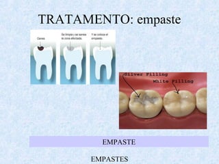 EMPASTES
EMPASTE
TRATAMENTO: empaste
 