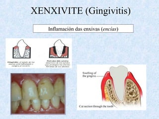 XENXIVITE (Gingivitis)
Inflamación das enxivas (encías)
 