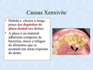 Causas Xenxivite
• Debida a efectos a longo
prazo dos depósitos de
placa dental nos dentes.
• A placa é un material
adherente composto de
bacterias, moco e refugos
de alimentos que se
acumula nas áreas expostas
do dente.
 