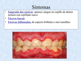 Síntomas
• Sangrado das enxivas: aparece sangue no cepillo de dentes
incluso cun cepillado suave
• Úlceras bucais
• Enxivas inflamadas, de aspecto brillante e moi sensibles
 