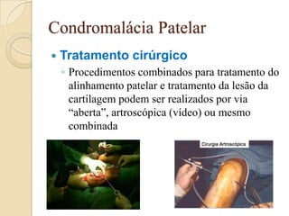 Condromalácia Patelar
   Tratamento cirúrgico
    ◦ Procedimentos combinados para tratamento do
      alinhamento patelar e tratamento da lesão da
      cartilagem podem ser realizados por via
      “aberta”, artroscópica (vídeo) ou mesmo
      combinada
 