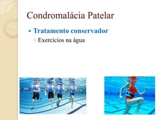 Condromalácia Patelar
   Tratamento conservador
    ◦ Exercícios na água
 