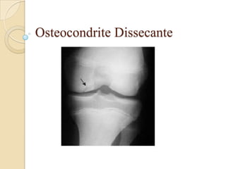 Osteocondrite Dissecante
 
