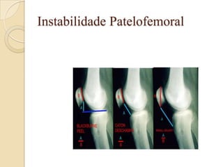 Instabilidade Patelofemoral
 
