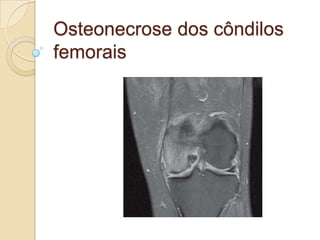 Osteonecrose dos côndilos
femorais
 