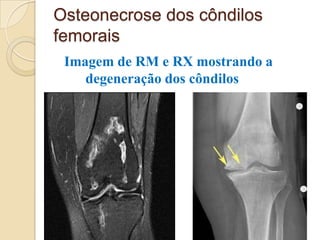 Osteonecrose dos côndilos
femorais
 Imagem de RM e RX mostrando a
    degeneração dos côndilos
 