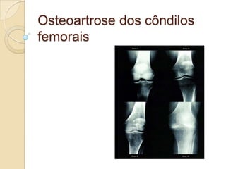 Osteoartrose dos côndilos
femorais
 