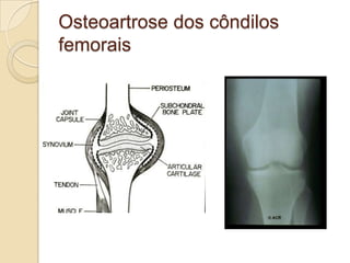 Osteoartrose dos côndilos
femorais
 