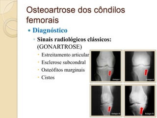 Osteoartrose dos côndilos
femorais
   Diagnóstico
    ◦ Sinais radiológicos clássicos:
      (GONARTROSE)
        Estreitamento articular
        Esclerose subcondral
        Osteófitos marginais
        Cistos
 
