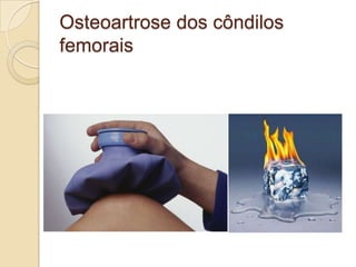 Osteoartrose dos côndilos
femorais
 
