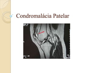 Condromalácia Patelar
 