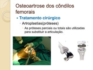 Osteoartrose dos côndilos
femorais
   Tratamento cirúrgico
    ◦ Artroplastias(próteses)
      As próteses parciais ou totais são utilizadas
       para substituir a articulação.
 
