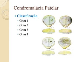 Condromalácia Patelar
   Classificação
    ◦   Grau 1
    ◦   Grau 2
    ◦   Grau 3
    ◦   Grau 4
 