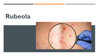 Rubeola
 