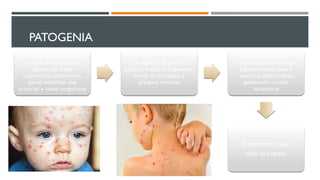 PATOGENIA
El virus logra acceso al
cuerpo invadiendo los
tejidos del árbol
respiratorio, conjuntivas,
pared intestinal, vías
urinarias y vasos sanguíneos
Se replica y llega a los
ganglios linfáticos regionales,
donde se multiplica y
produce viremias
Arriba a las células
linforreticulares del bazo,
hígado, medula ósea y
continua replicándose
generando viremia
secundaria
Diseminación por
todo el cuerpo.
 