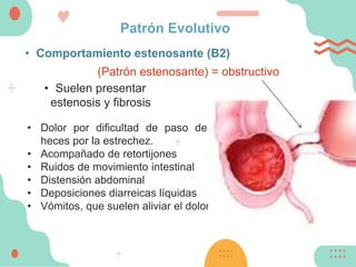 Patrón Evolutivo
• Comportamiento estenosante (B2)
• Suelen presentar
estenosis y fibrosis
• Dolor por dificultad de paso de las
heces por la estrechez.
• Acompañado de retortijones
• Ruidos de movimiento intestinal
• Distensión abdominal
• Deposiciones diarreicas líquidas
• Vómitos, que suelen aliviar el dolor.
(Patrón estenosante) = obstructivo
 