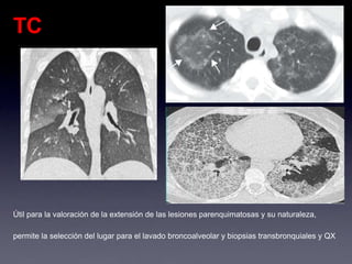 TC
Útil para la valoración de la extensión de las lesiones parenquimatosas y su naturaleza,
permite la selección del lugar para el lavado broncoalveolar y biopsias transbronquiales y QX
 