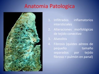 Anatomia Patologica
1. Infiltrados inflamatorios
intersticiales
2. Alteraciones morfológicas
de tejido conectivo
3. Alveolitis
4. Fibrosis (quistes aéreos de
pequeño tamaño
separados por tejido
fibroso = pulmón en panal)
 