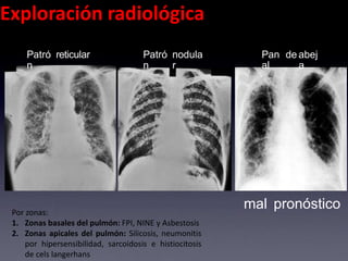 Exploración radiológica
Patró
n
reticular Patró
n
nodula
r
Pan
al
de abej
a
mal pronósticoPor zonas:
1. Zonas basales del pulmón: FPI, NINE y Asbestosis
2. Zonas apicales del pulmón: Silicosis, neumonitis
por hipersensibilidad, sarcoidosis e histiocitosis
de cels langerhans
 
