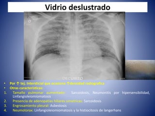 Vidrio deslustrado
• Por ↑ tej. Intersticial que ocasiona ↑densidad radiografica
• Otras caracteristicas:
1. Tamaño pulmonar aumentado: Sarcoidosis, Neumonitis por hipersensibilidad,
Linfangioleiomiomatosis
2. Presencia de adenopatias hiliares simetricas: Sarcoidosis
3. Engrosamiento pleural: Asbestosis
4. Neumotorax: Linfangioleiomiomatosis y la histiocitosis de langerhans
 
