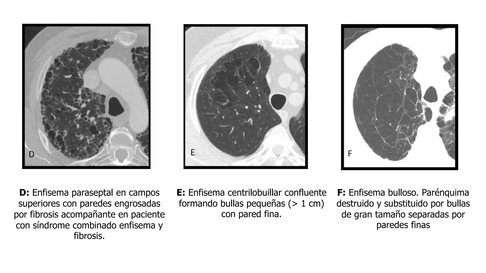 Tipos de enfisema y semiologia del enfisema | PPT