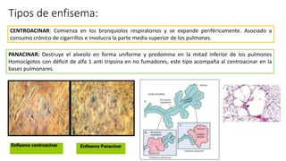 Tipos de enfisema y semiologia del enfisema | PPT